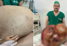 Paciente que removeu tumor de 46 kg morre 11 dias após cirurgia